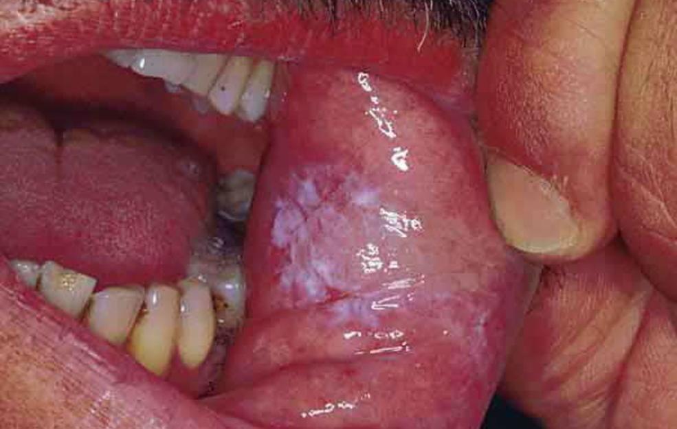 Infections in the mouth