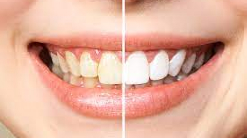 What are the Benefits of Teeth Whitening?